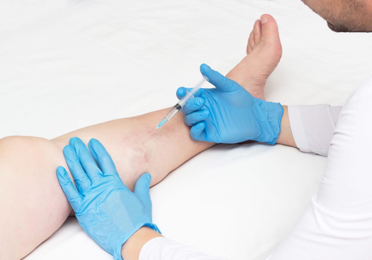 Are you wondering, “How long do vein injections last for varicose veins and spider veins?” With the right vein doctor, a vein treatment in 2022 lasts forever. 